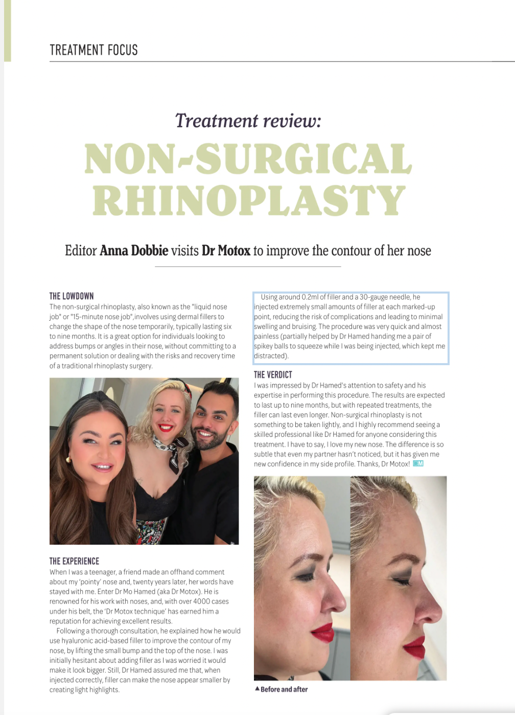 Treatment Review: Non-surgical Rhinoplasty