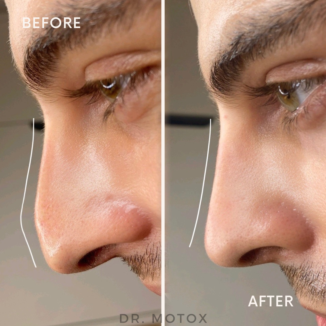 The "Lunch Break" Makeover: Why Non-Surgical Rhinoplasty Is So Popular  Dr  Motox