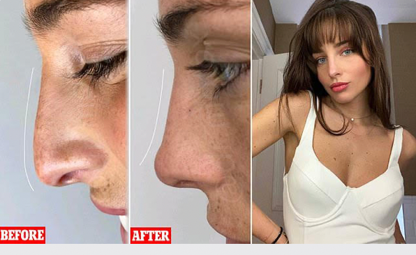 Dr Motox Non Surgical Nose Job - Maeva Made in Chelsea