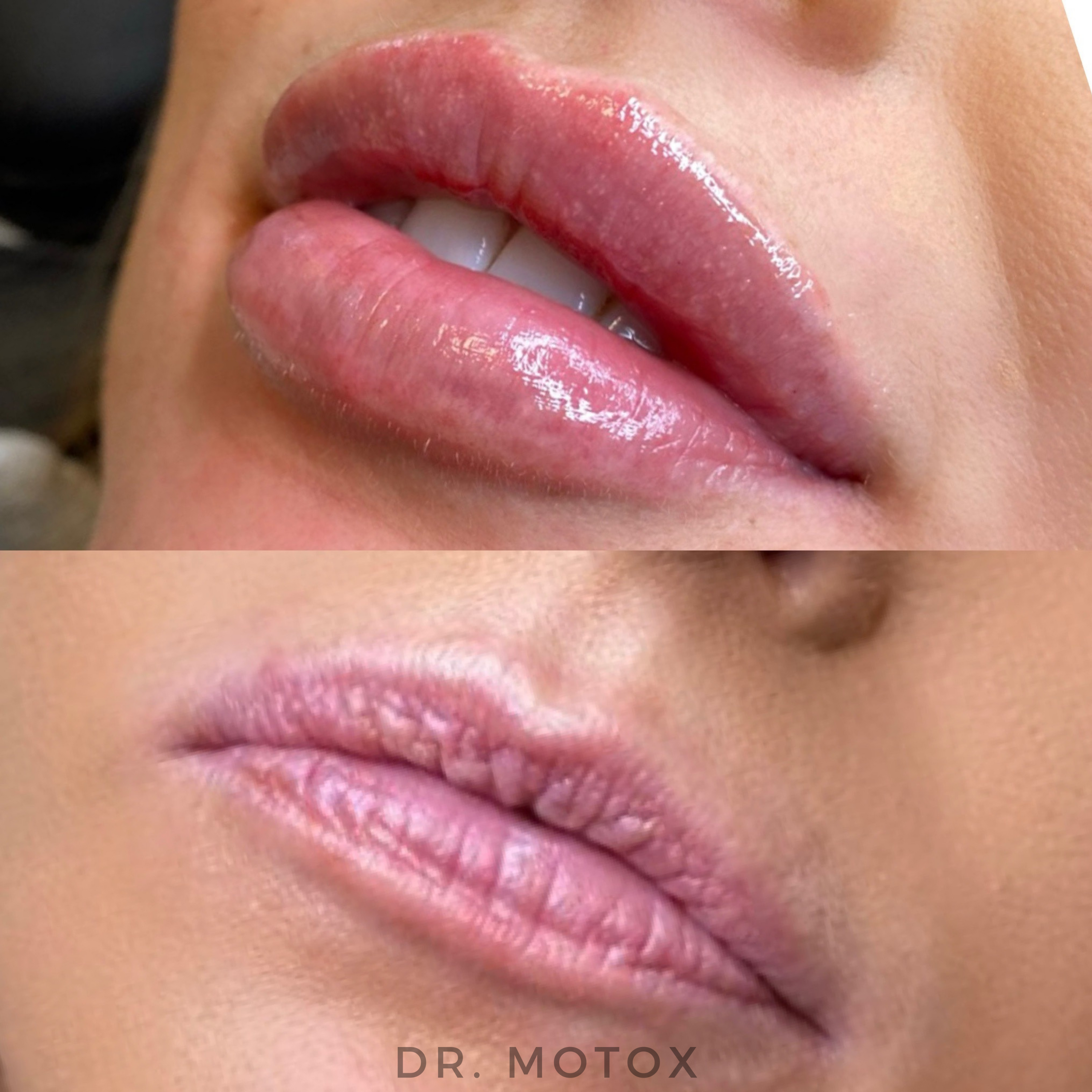 Lip Fillers: The Secret to Achieving Natural, Beautiful Results