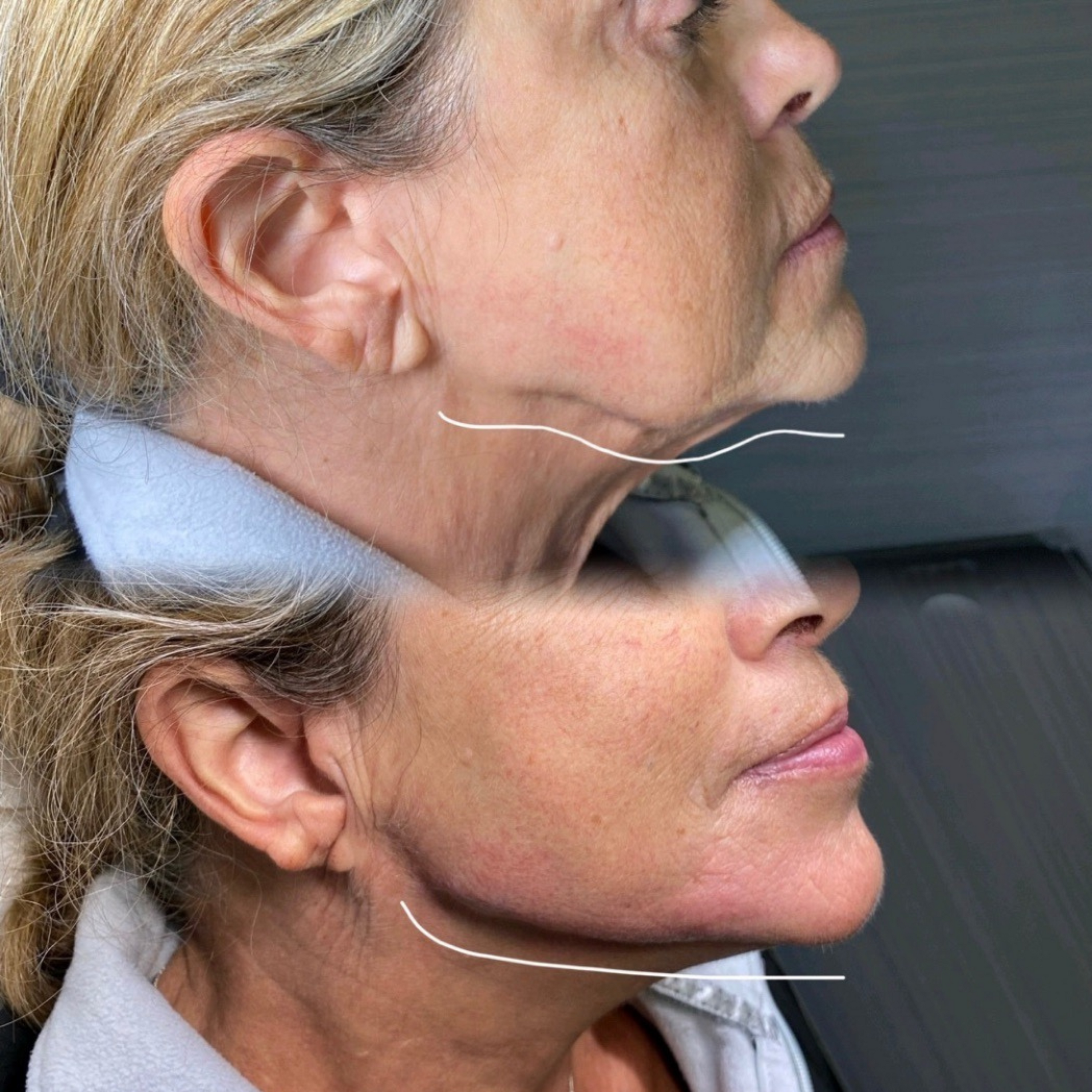 Why We Don’t Recommend Jawline Filler for Younger Clients